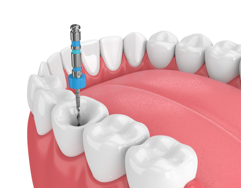 Example of a root canal procedure by Dr. Jebrini