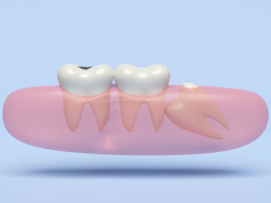 an impacted wisdom tooth